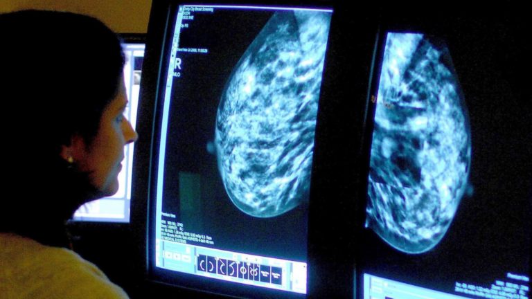 Scientists shed new mild on how early stage breast most cancers spreads to different organs